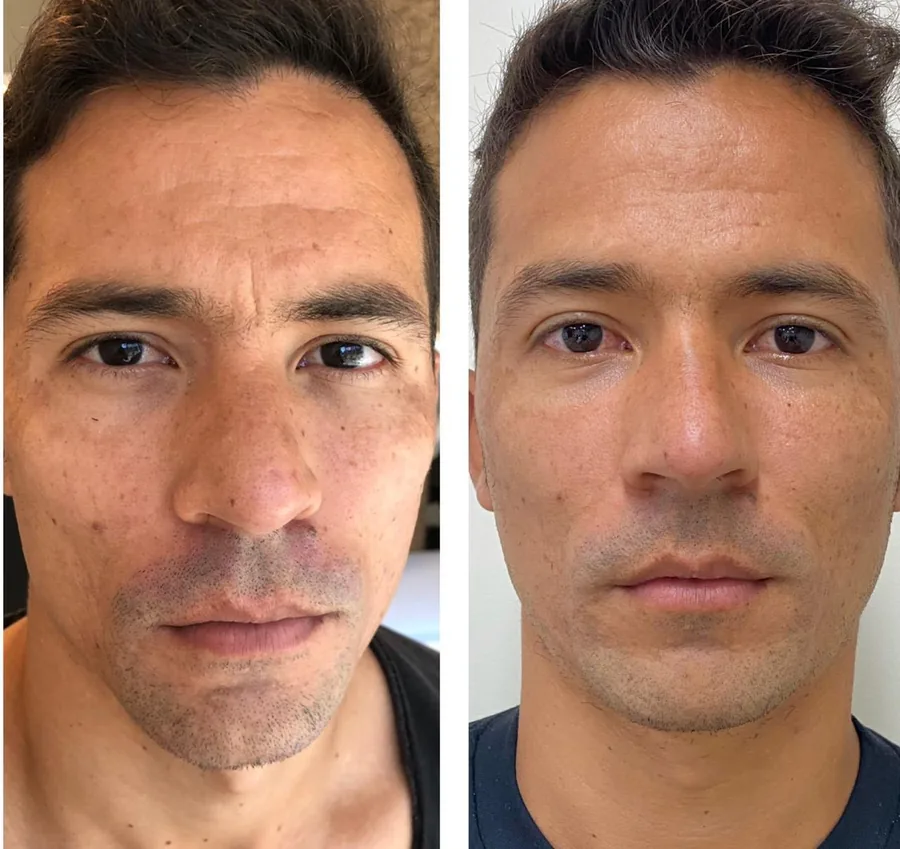 Antes e depois de laser Lavieen em paciente masculino: manchas e textura irregular na face