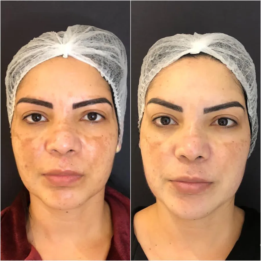 Antes e depois de laser Lavieen: manchas no rosto, vista frontal