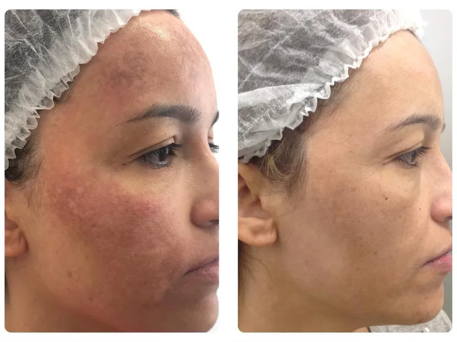 Antes e depois de laser Lavieen: manchas e vermelhidão na face